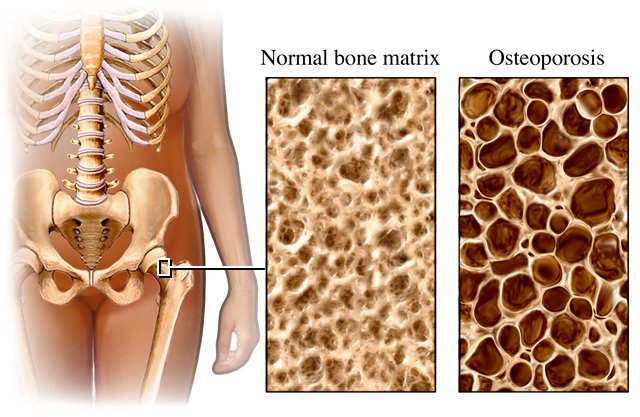exercise-bone-effects-osteoporosis.jpg